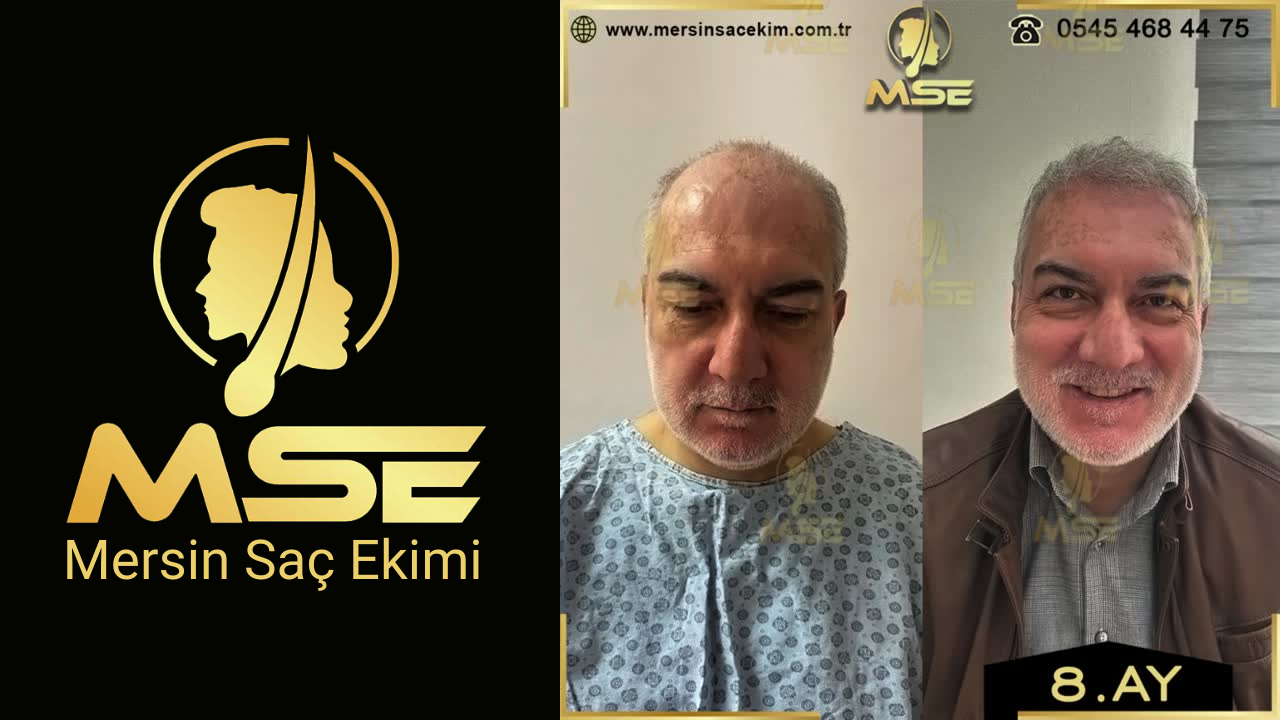 Mersin Saç Ekimi